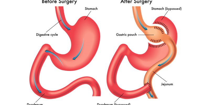 Gastric-Bypass-Melbourne